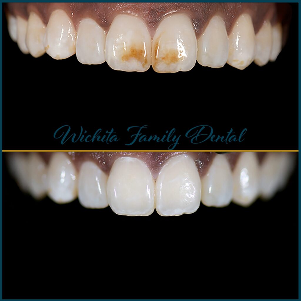 Before and after dental treatment at Wichita Family Dental, showcasing significant oral health improvements.