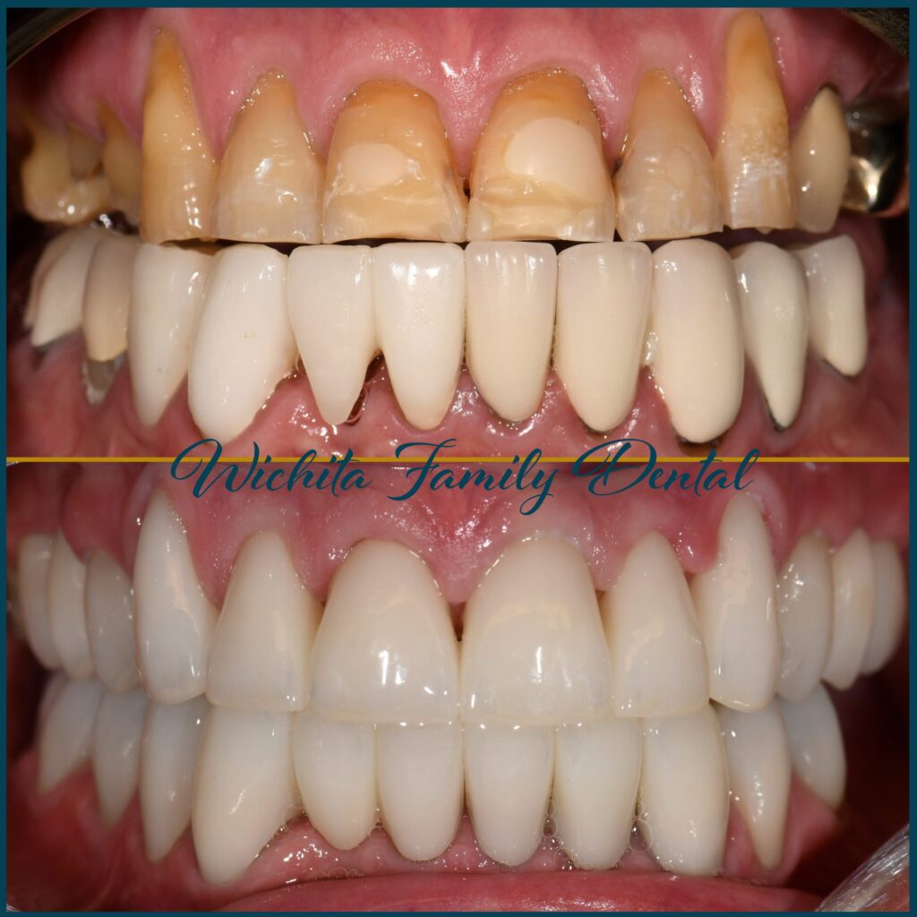 Before and after images at Wichita Family Dental depicting improvements in dental appearance and function.