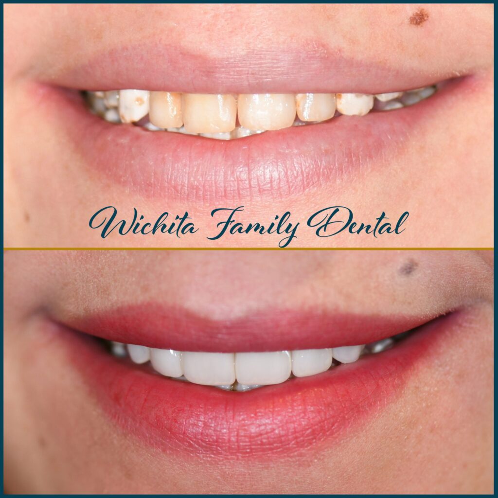 Smile transformation at Wichita Family Dental in Wichita, KS, with visible enhancements in before and after photos.