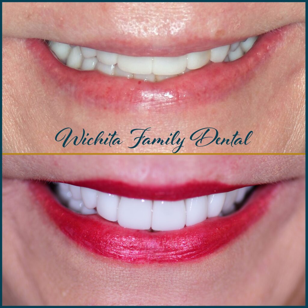 Oral health rehabilitation before and after images at Wichita Family Dental, showing comprehensive dental corrections.