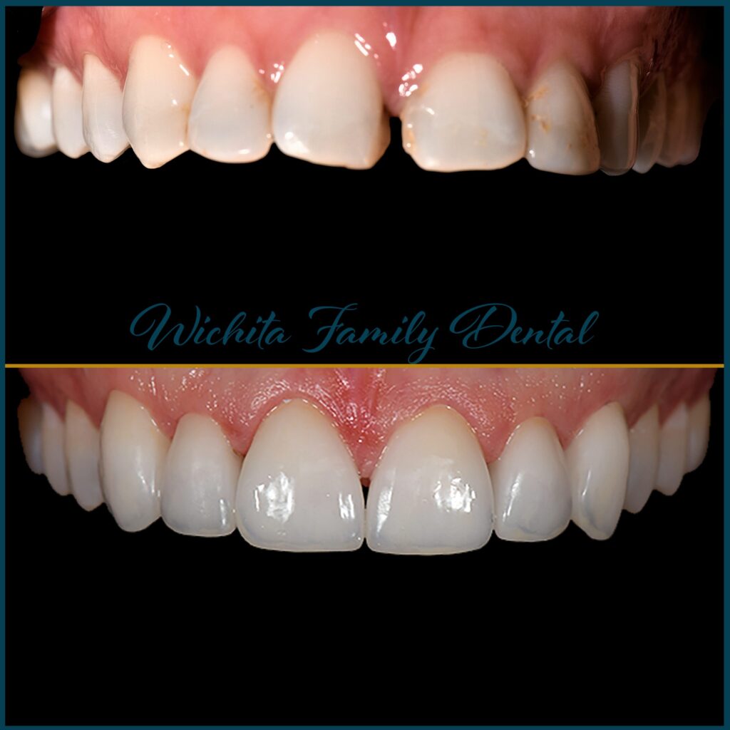 Cosmetic dental improvements at Wichita Family Dental, evident in before and after snapshots, enhancing smile aesthetics.