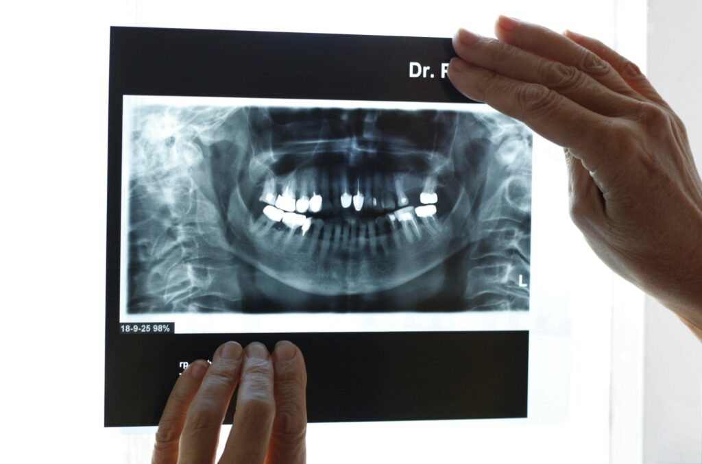 X-ray image showing detailed tooth structure, used for diagnostic purposes at Wichita Family Dental.