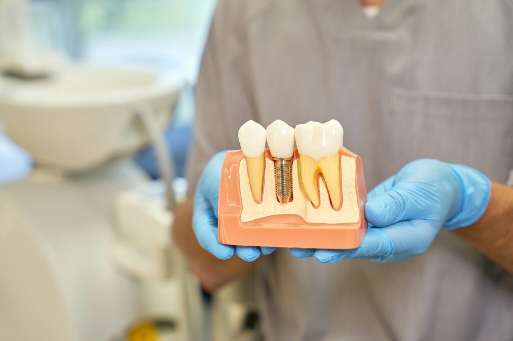 Cropped shot of dental implant model in hands of dentist